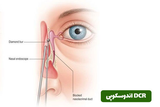 هزینه عمل مجرای اشکی