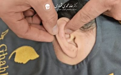 اتوپلاستی گوش نی نی سایت