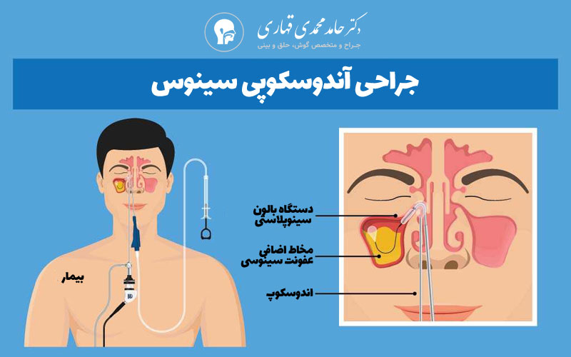 جراحی آندوسکوپی سینوس