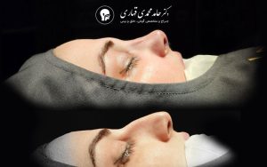 پیزوسرجری بینی