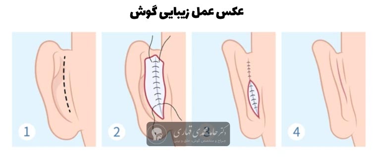 عکس عمل زیبایی گوش