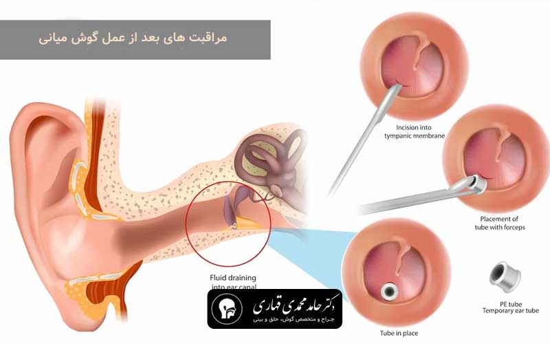 مراقبت بعد از عمل گوش میانی