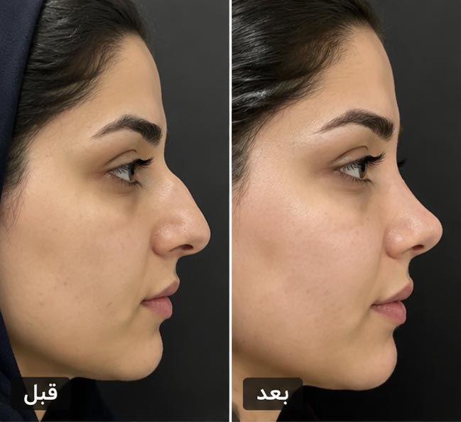 عکس قبل و بعد رینوپلاستی 1
