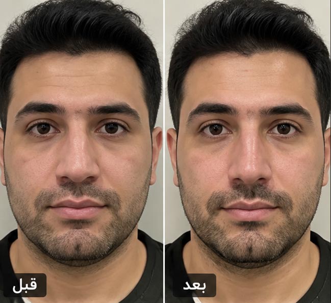 عکس قبل و بعد رینوپلاستی 2