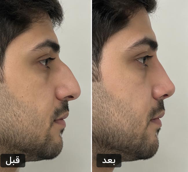 عکس قبل و بعد رینوپلاستی 3