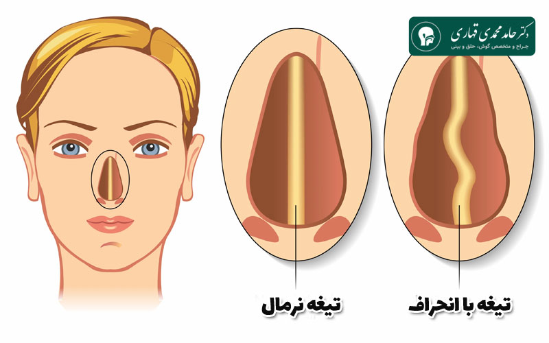 هزینه عمل انحراف بینی در سال 1403