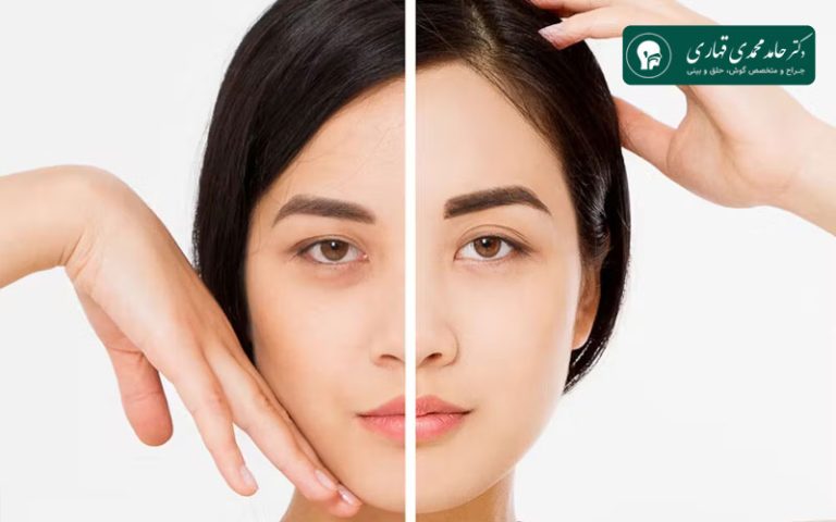 عکس قبل و بعد لیفت پیشانی 2