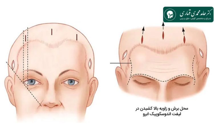 مراقبتهای قبل و بعد از لیفت اندوسکوپیک