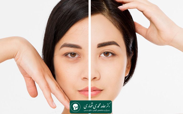 نمونه عکس قبل و بعد لیفت پیشانی