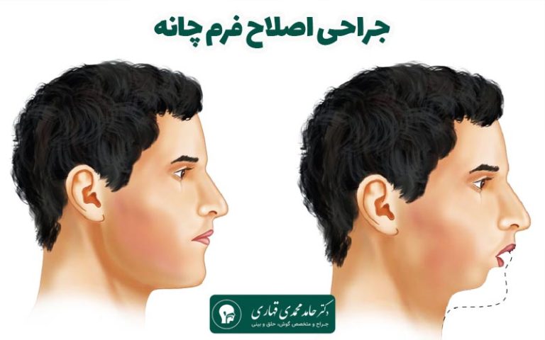 جراحی اصلاح فرم چانه