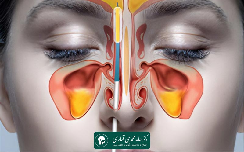 عمل توربینوپلاستی