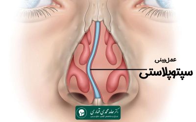سپتوپلاستی بینی چیست