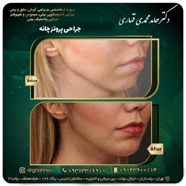 هزینه پروتز چانه 1404 5 عکس قبل و بعد جراحی پروتز چانه 2