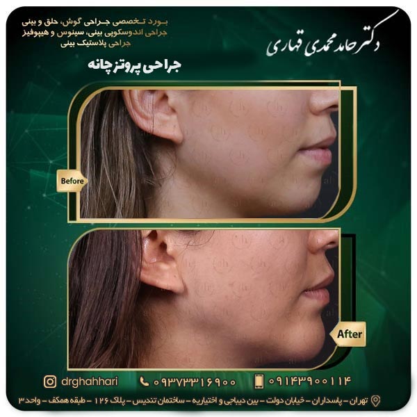 هزینه پروتز چانه 1404 4 عکس قبل و بعد جراحی پروتز چانه