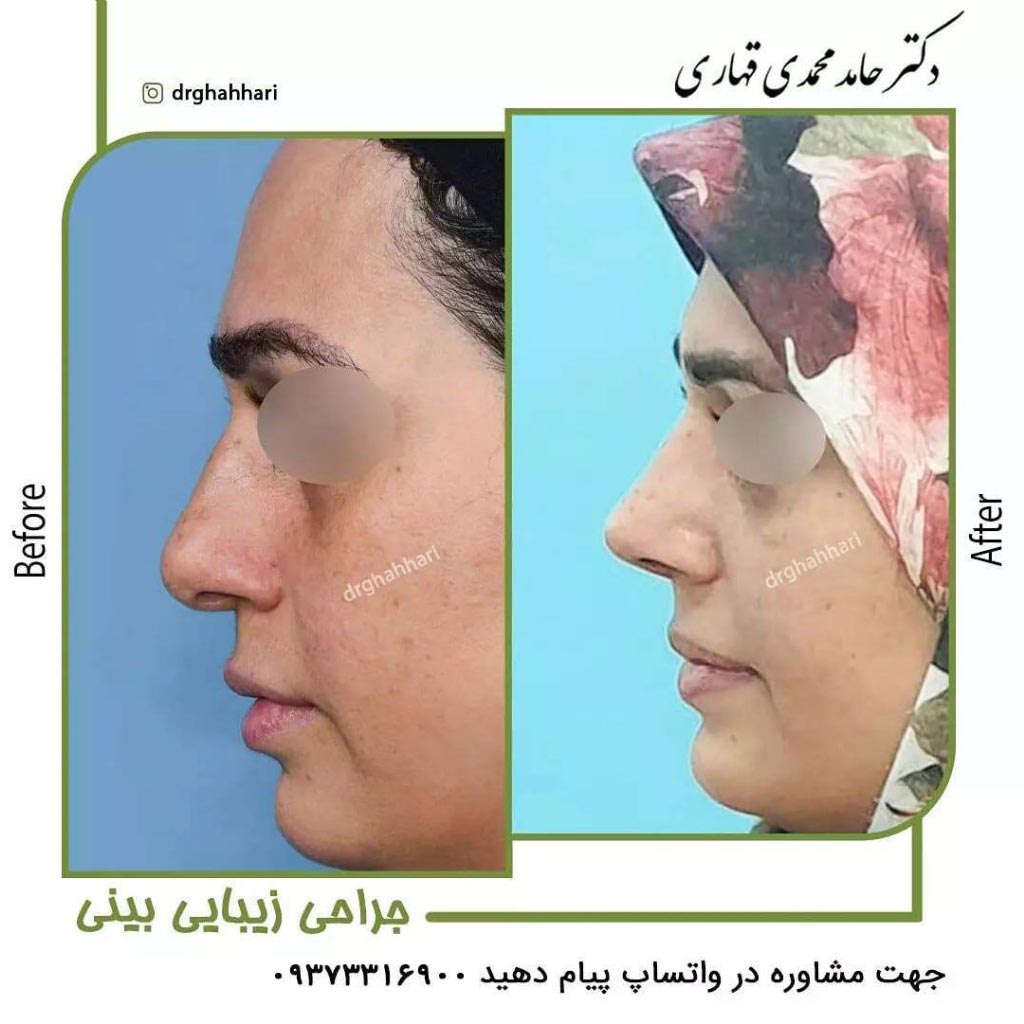 عمل رینو پلاستی چیست 5 عکس قبل و بعد عمل رینو پلاستی 2