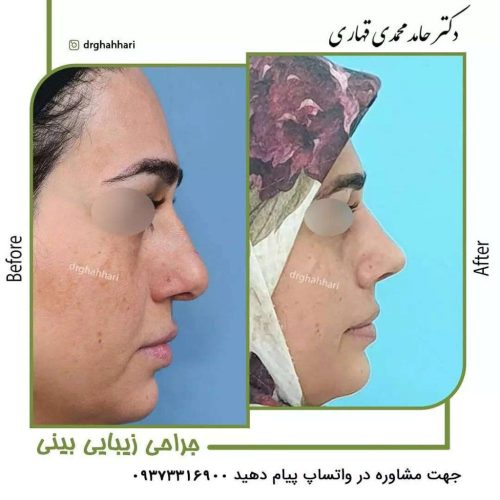 عکس قبل و بعد عمل رینو پلاستی