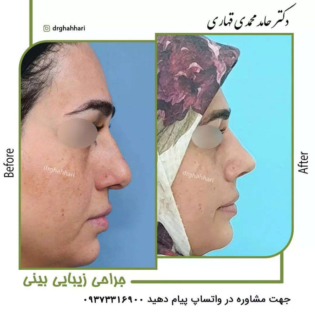 عمل رینو پلاستی چیست 4 عکس قبل و بعد عمل رینو پلاستی
