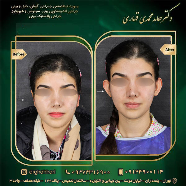هزینه جراحی گوش برجسته