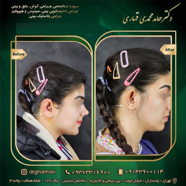 هزینه جراحی گوش برجسته