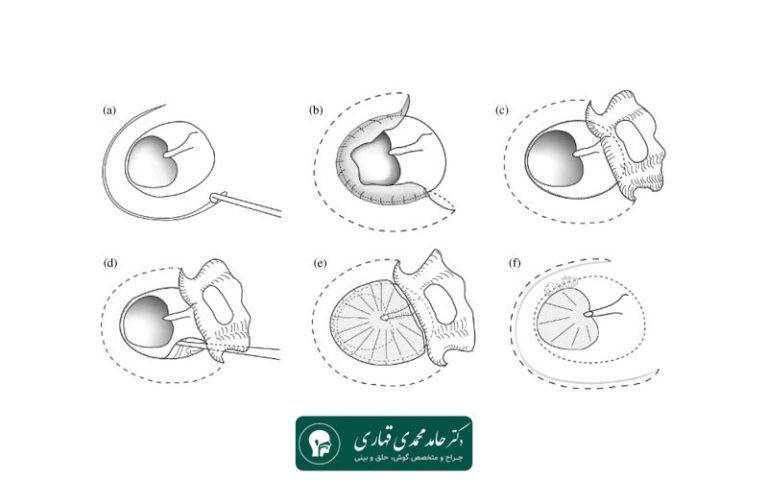 روند جراحی تمپانوپلاستی با آندوسکوپی