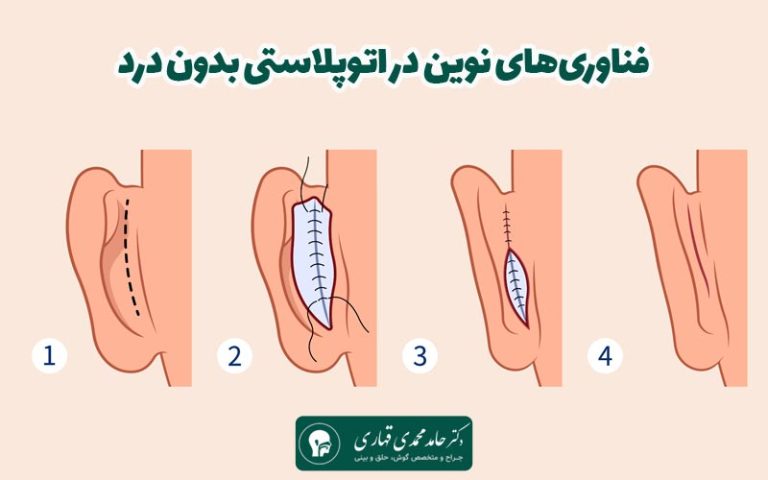 فناوری‌های نوین در اتوپلاستی بدون درد