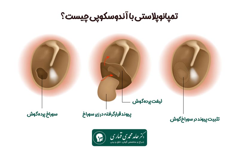 تمپانوپلاستی با آندوسکوپی چیست؟