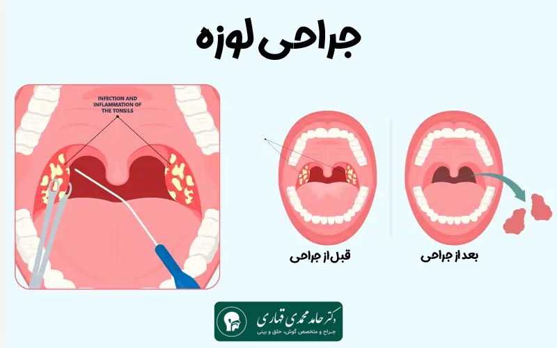 عوامل موثر بر هزینه جراحی لوزه