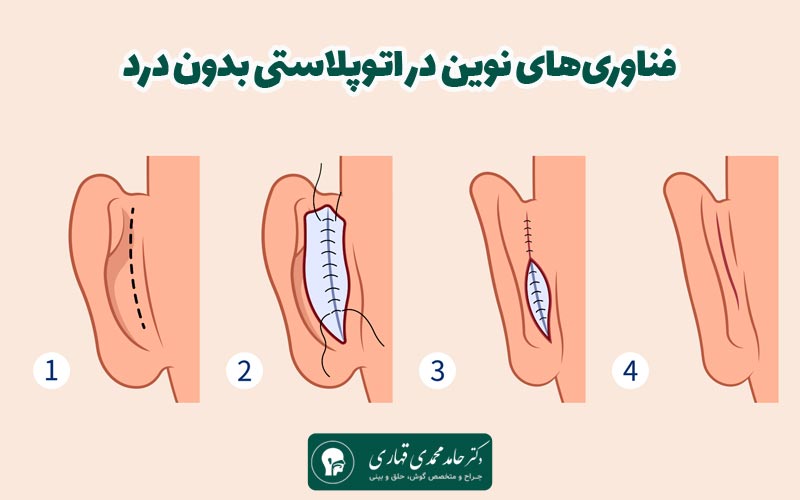 فناوری‌های نوین در اتوپلاستی بدون درد