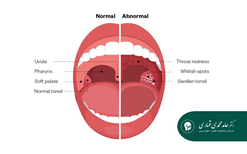 برای عفونت گلو چه آنتی بیوتیکی خوبه 3 تشخیص نوع عفونت گلو