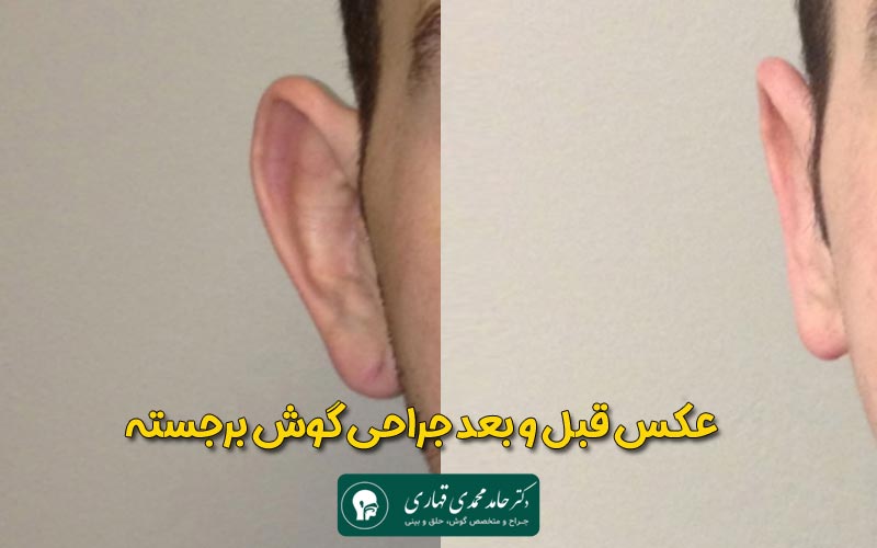 عکس قبل و بعد جراحی گوش برجسته