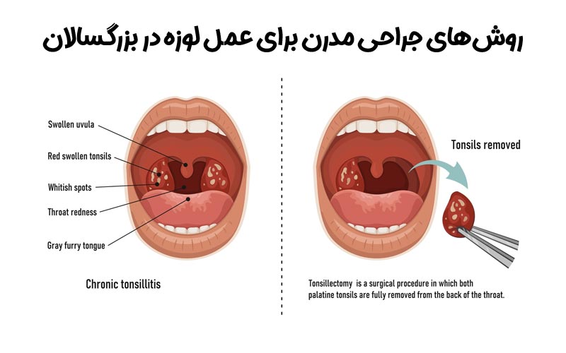 روش‌های جراحی مدرن برای عمل لوزه در بزرگسالان