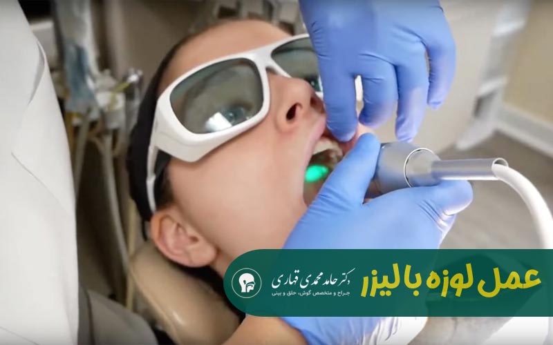 عمل لوزه در بزرگسالان با لیزر
