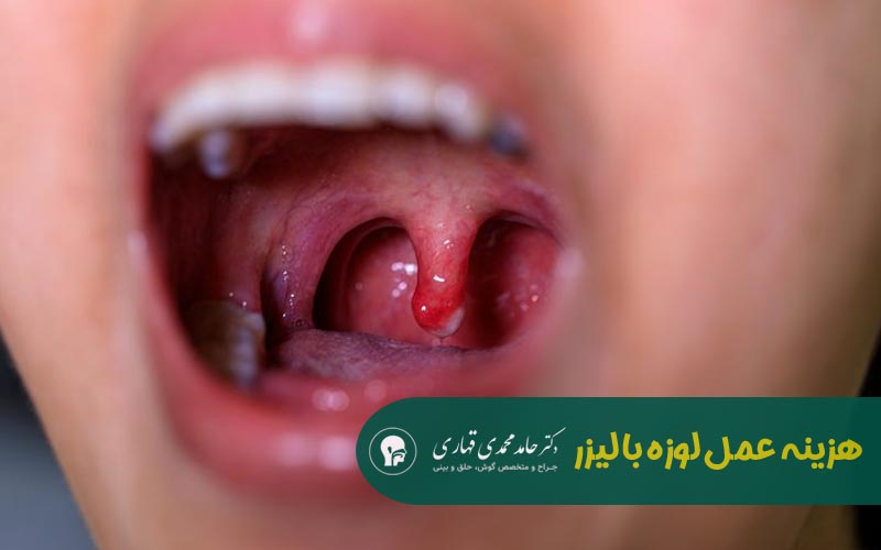 عمل لوزه در بزرگسالان 6 هزینه عمل لوزه در بزرگسالان