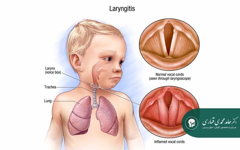 بیماری های حلق و حنجره در کودکان