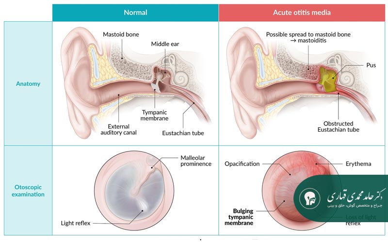 عفونت گوش در کودکان 6 ساله 6 تفاوت عفونت گوش میانی و خارجی