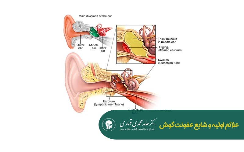عفونت گوش در کودکان 6 ساله 3 علائم اولیه و شایع عفونت گوش