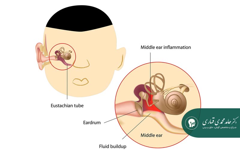 علت‌های اصلی عفونت گوش در کودکان ۶ ساله