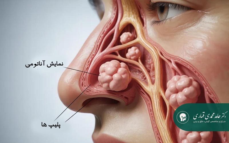 پولیپ بینی دقیقاً چیست؟