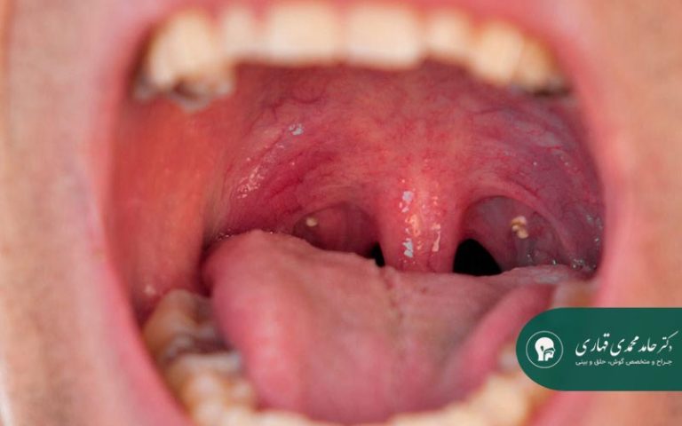 سنگ لوزه چیست؟ علائم، پیشگیری و درمان قطعی