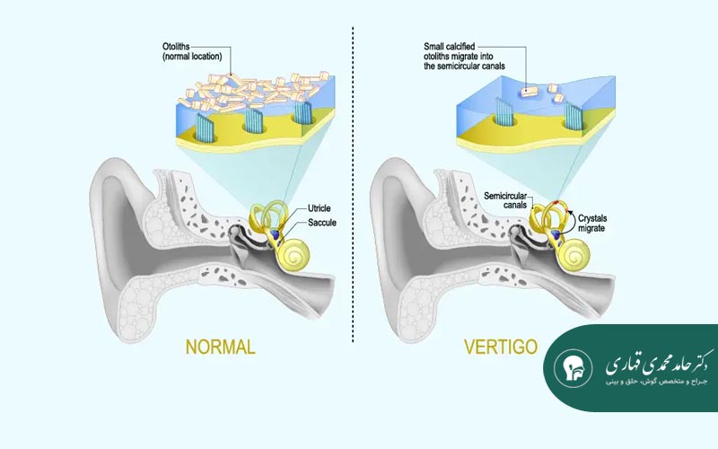 علت سرگیجه ناگهانی چیست؟ تشخیص و درمان سرگیجه گوش داخلی 3 علت سرگیجه واقعی و تفاوت با سرگیجه سبکی سر