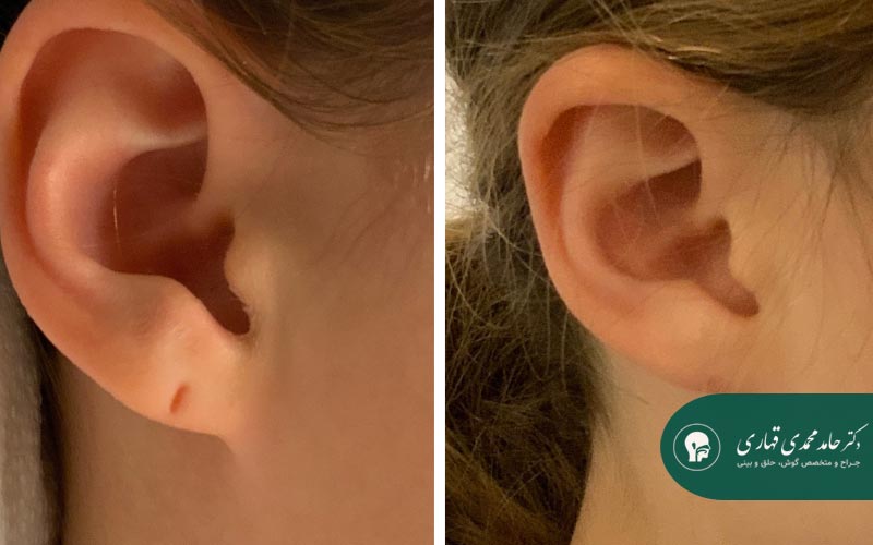جراحی ترمیم نرمه گوش 3 علل اصلی پارگی و کشیدگی سوراخ گوش