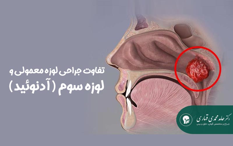 تفاوت جراحی لوزه معمولی و لوزه سوم (آدنوئید)