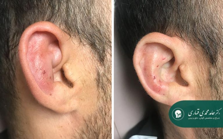 بخیه های اتوپلاستی چه نقشی در جراحی گوش دارند؟