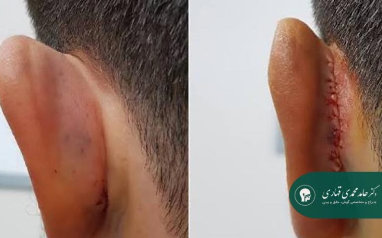 بخیه های جذبی در اتوپلاستی چه کاربردی دارند؟