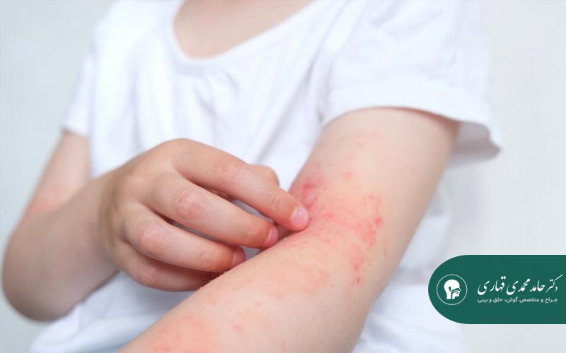 آلرژی و نقش آن در گرفتگی بینی کودکان