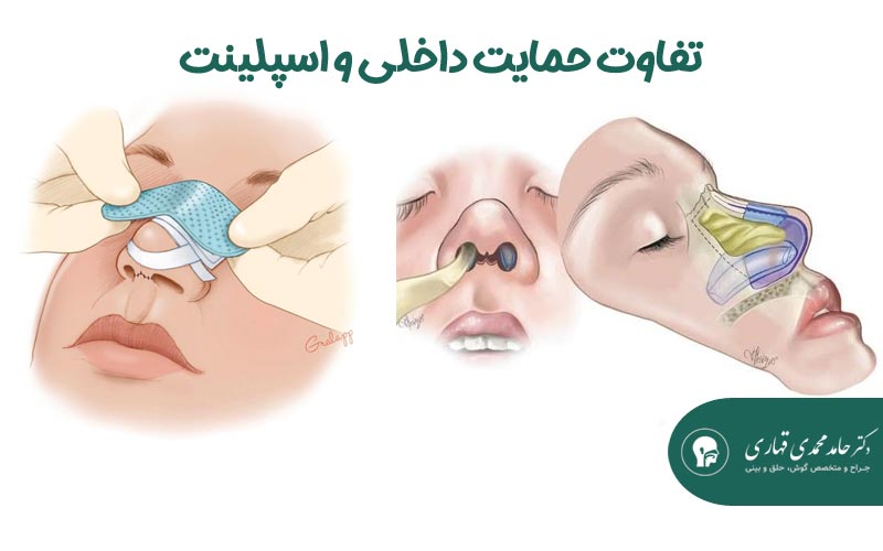تفاوت حمایت داخلی و اسپلینت