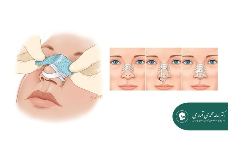 مراقبت و استفاده از اسپلینت پس از جراحی بینی