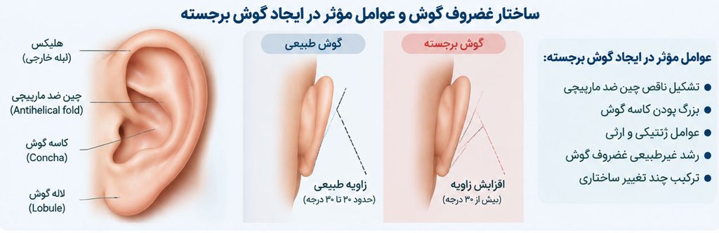 علت ایجاد گوش برجسته و تغییرات غضروف گوش