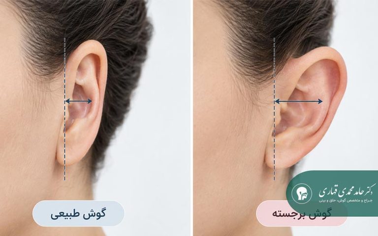 مراقبتهای مهم شبهای اول بعد از اتوپلاستی