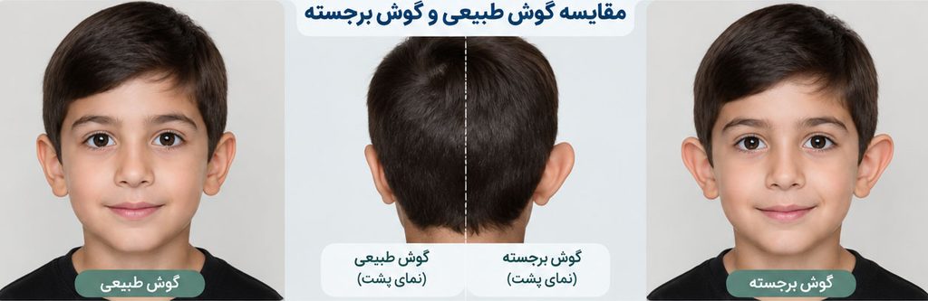 مقایسه گوش طبیعی و گوش برجسته